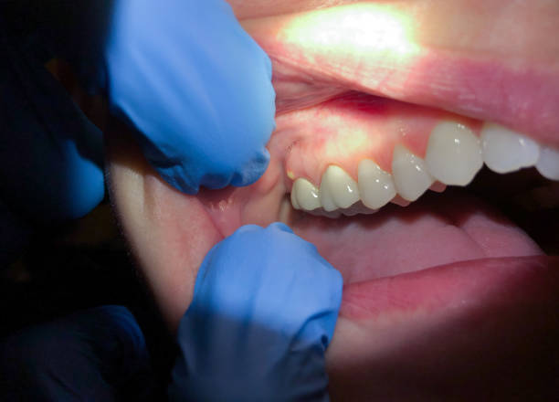 Best Chipped Tooth Repair Near Me  in Castalia, OH