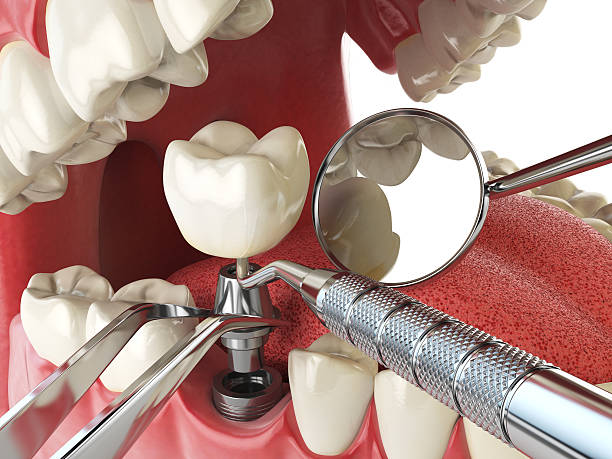 Best Knocked-Out Tooth Emergency  in Castalia, OH